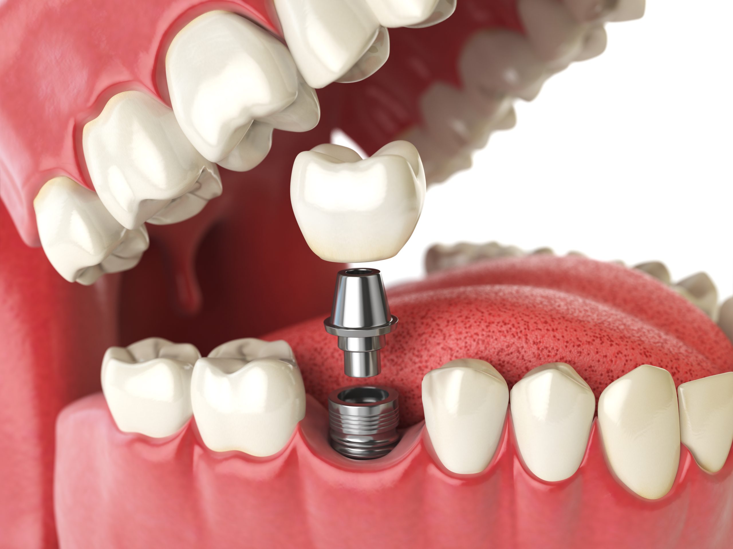 Are Dental Implants For Real?