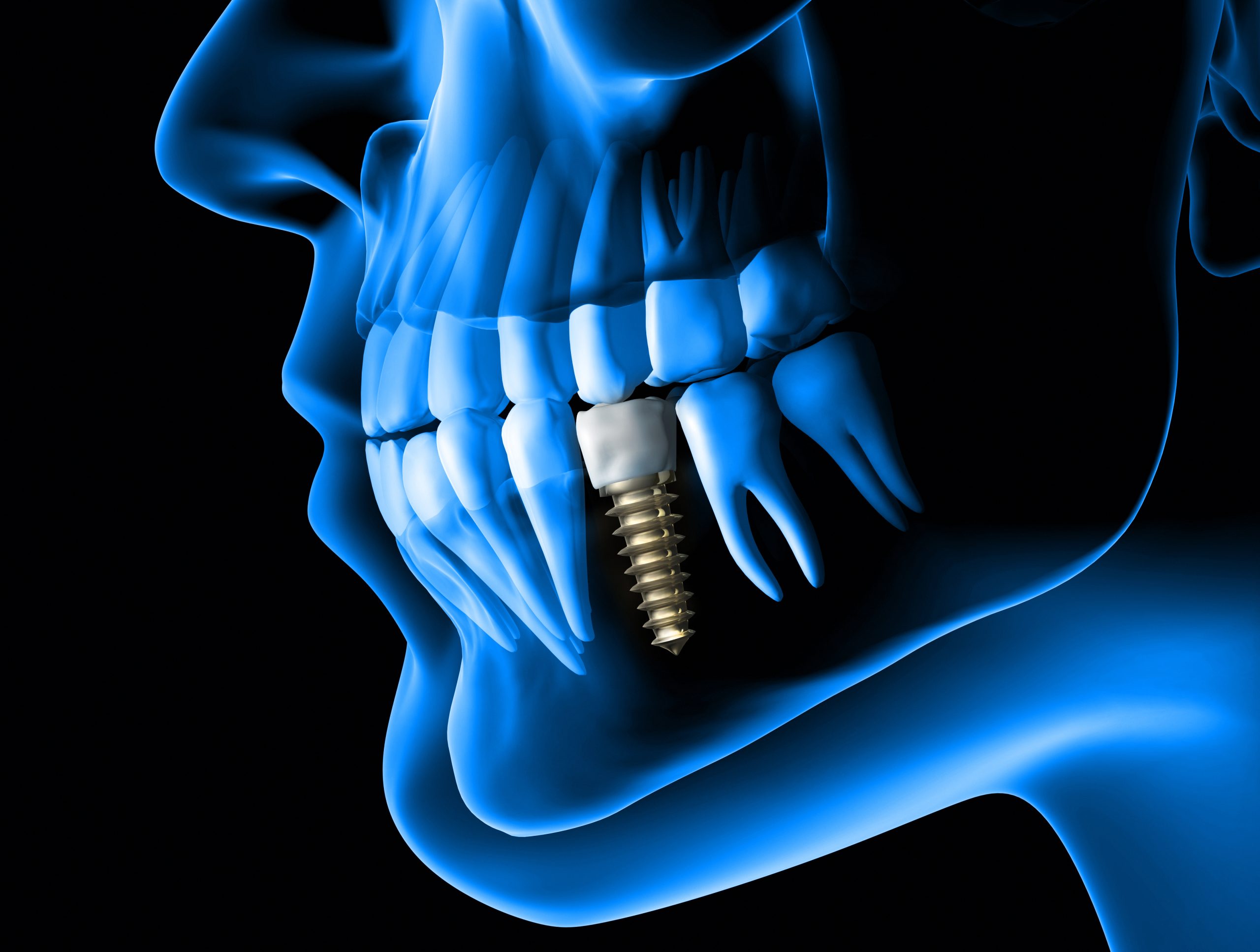 Why Is An Implant Better For Oral Health?