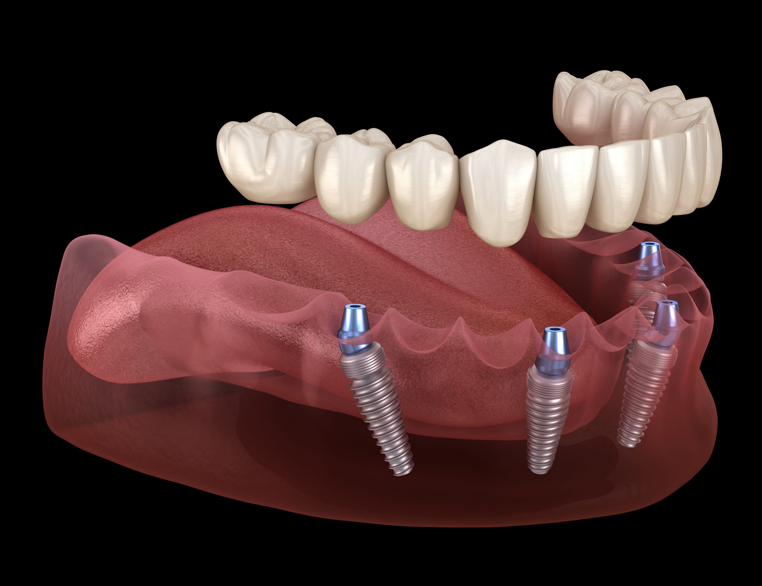Dental Implants Are Truly Life-Changing