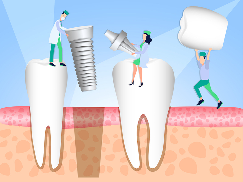 Why Is The 4-Step Tooth Implant Timeline Necessary?